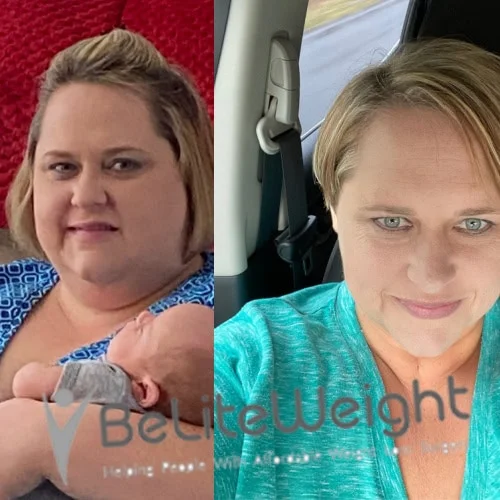 Weight Loss Surgery Before And After